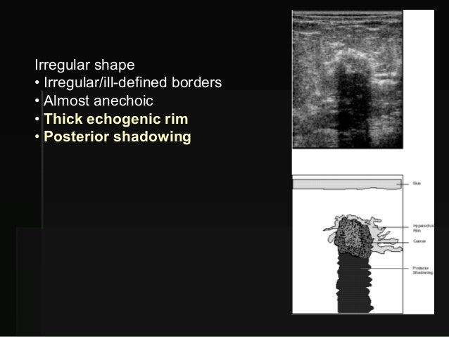 breast ultrasound shadow Breast ultrasound shadow